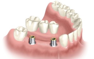 cấy ghép răng implant là gì